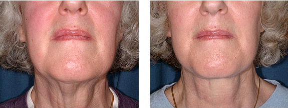 Before And After Photos Mountain View - Face and Neck Lifting Image 13