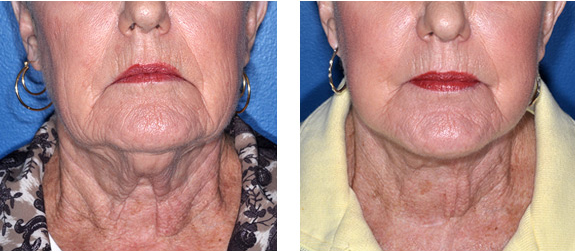 Before And After Photos Mountain View - Face and Neck Lifting Image 06