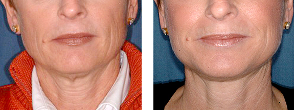 Before And After Photos Mountain View - Face and Neck Lifting Image 07