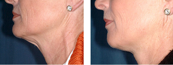 Before And After Photos Mountain View - Face and Neck Lifting Image 08