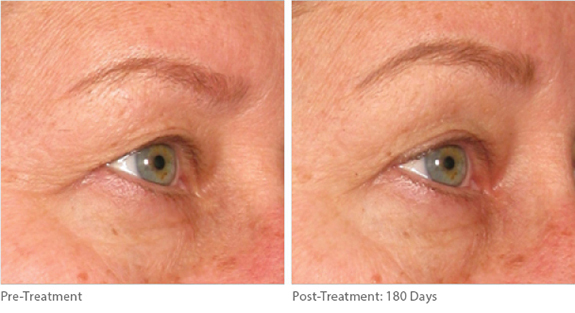 Before And After Photos Mountain View - Ultherapy Image 01
