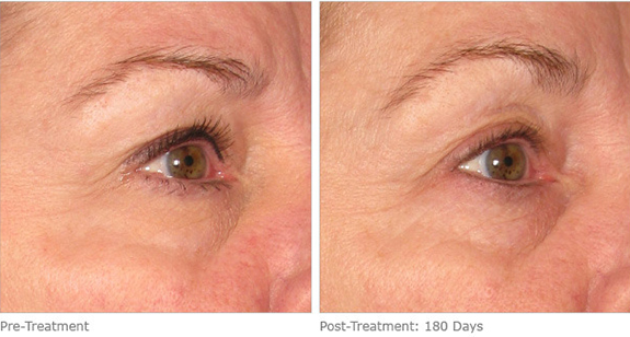 Before And After Photos Mountain View - Ultherapy Image 11