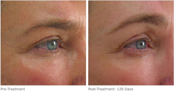 Before And After Photos Mountain View - Ultherapy Image 12