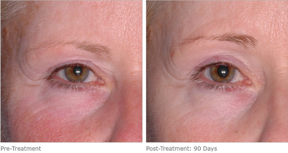 Before And After Photos Mountain View - Ultherapy Image 13