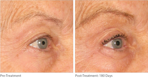 Before And After Photos Mountain View - Ultherapy Image 02