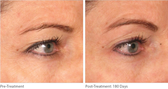 Before And After Photos Mountain View - Ultherapy Image 04