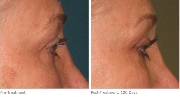 Before And After Photos Mountain View - Ultherapy Image 07