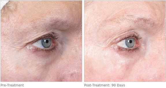 Before And After Photos Mountain View - Ultherapy Image 09