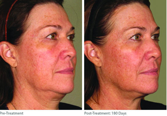 Before And After Photos Mountain View - Ultherapy Image 01