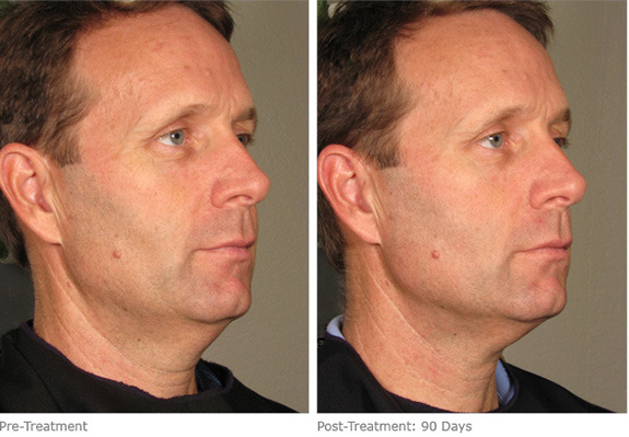 Before And After Photos Mountain View - Ultherapy Image 10