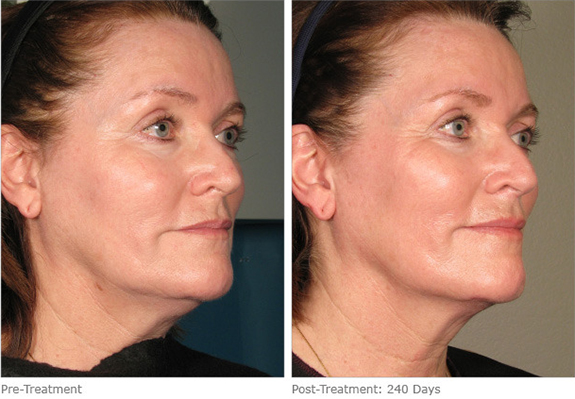 Before And After Photos Mountain View - Ultherapy Image 11