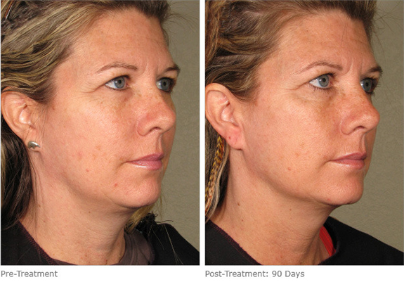 Before And After Photos Mountain View - Ultherapy Image 13