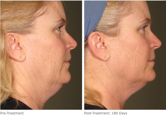 Before And After Photos Mountain View - Ultherapy Image 14