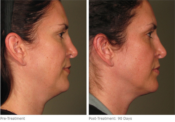 Before And After Photos Mountain View - Ultherapy Image 15