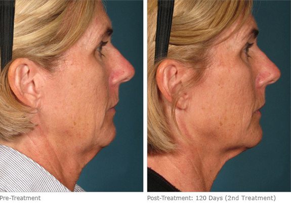 Before And After Photos Mountain View - Ultherapy Image 16