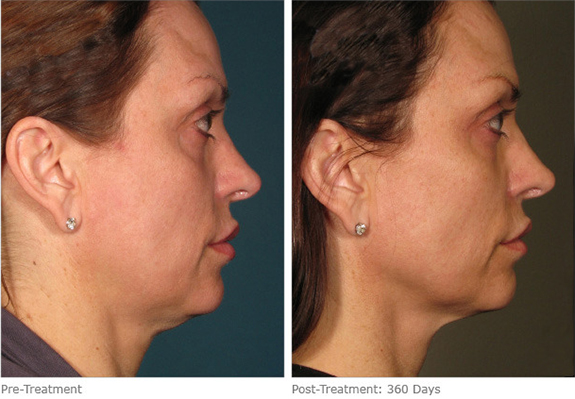 Before And After Photos Mountain View - Ultherapy Image 17