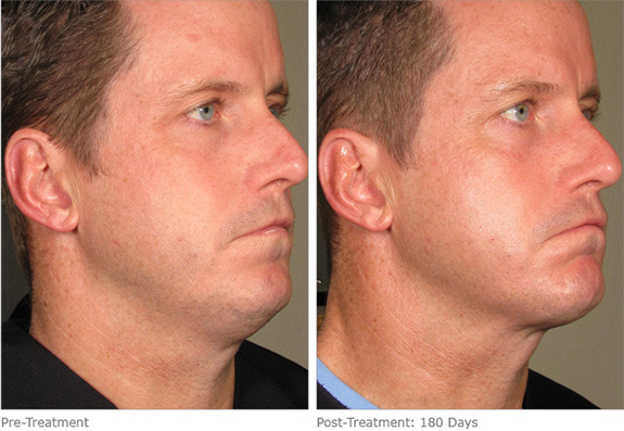 Before And After Photos Mountain View - Ultherapy Image 18