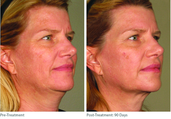 Before And After Photos Mountain View - Ultherapy Image 02