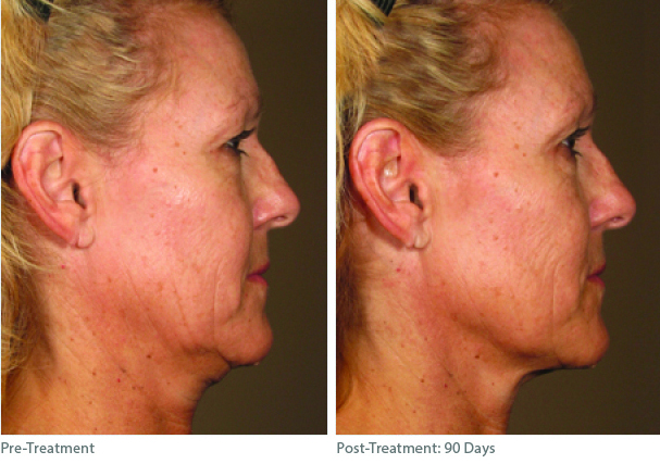 Before And After Photos Mountain View - Ultherapy Image 03