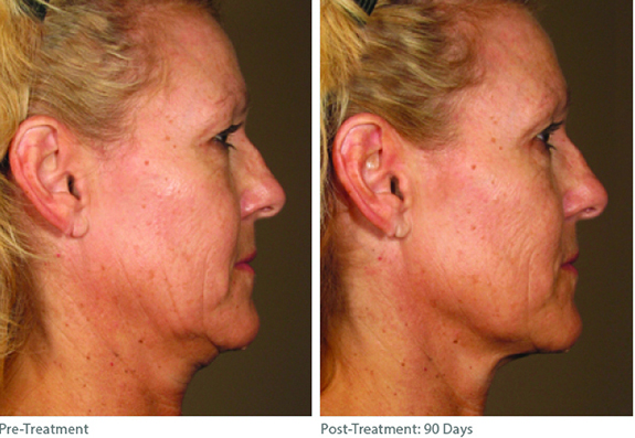Before And After Photos Mountain View - Ultherapy Image 04