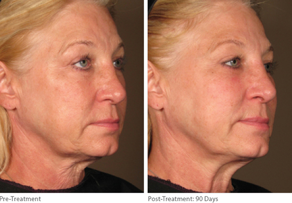 Before And After Photos Mountain View - Ultherapy Image 05