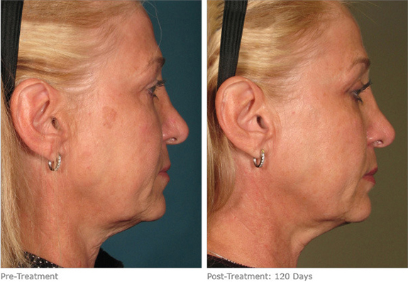 Before And After Photos Mountain View - Ultherapy Image 06