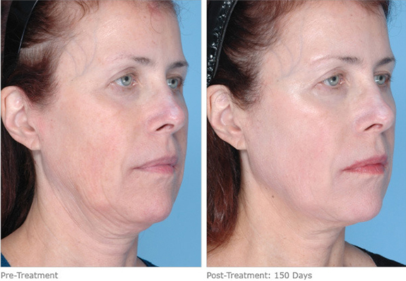 Before And After Photos Mountain View - Ultherapy Image 07