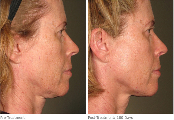 Before And After Photos Mountain View - Ultherapy Image 08