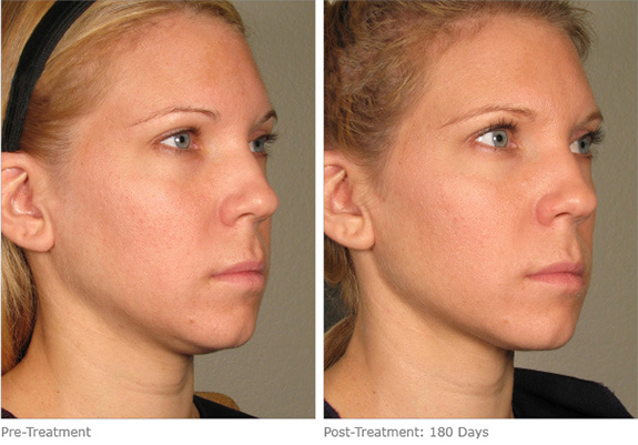 Before And After Photos Mountain View - Ultherapy Image 09