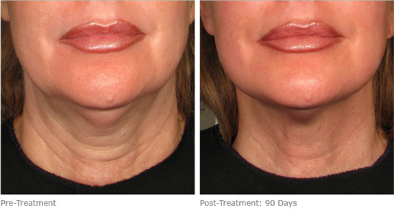 Before And After Photos Mountain View - Ultherapy Image 10