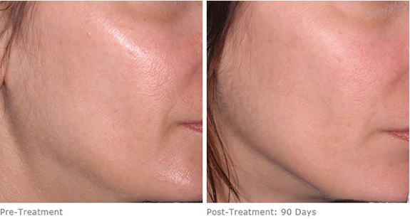 Before And After Photos Mountain View - Ultherapy Image 11