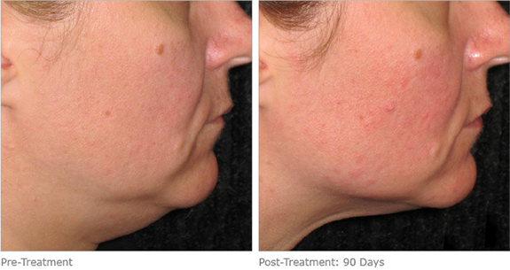 Before And After Photos Mountain View - Ultherapy Image 12