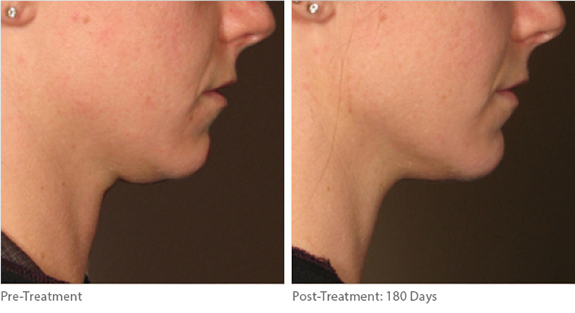 Before And After Photos Mountain View - Ultherapy Image 02