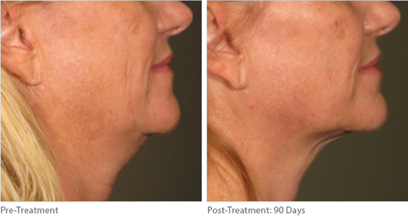 Before And After Photos Mountain View - Ultherapy Image 03