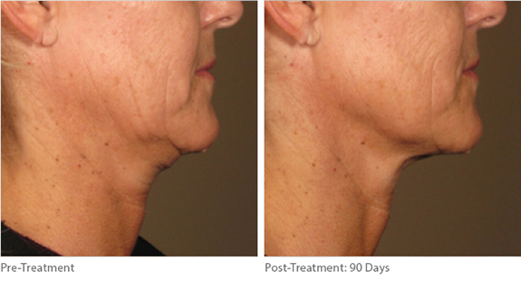 Before And After Photos Mountain View - Ultherapy Image 04