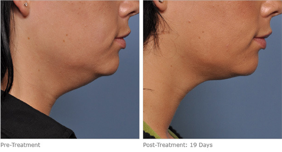 Before And After Photos Mountain View - Ultherapy Image 06
