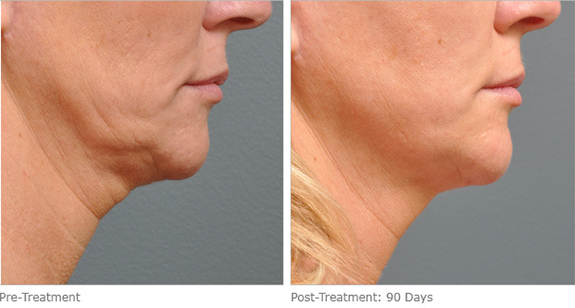 Before And After Photos Mountain View - Ultherapy Image 07