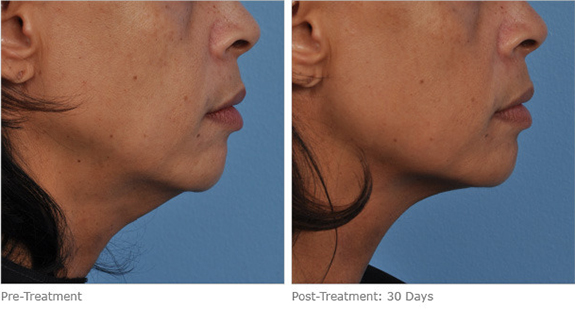 Before And After Photos Mountain View - Ultherapy Image 08