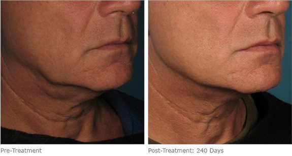 Before And After Photos Mountain View - Ultherapy Image 09