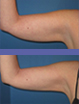 Dermatologist Mountain View - Smartlipo