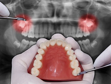 Digital X-Rays For Teeth Bloomington