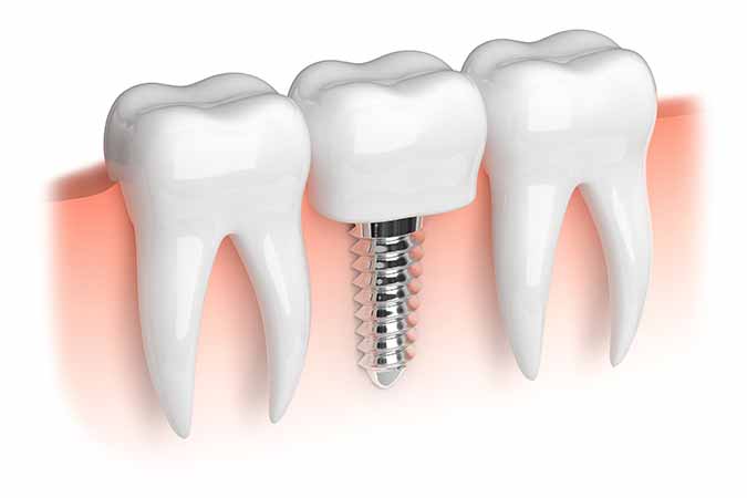 Learn about tooth replacement options such as dental implants from Dublin dentist
