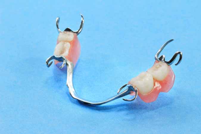 Dublin, CA area dentist offers partial dentures as a replacement service for missing teeth