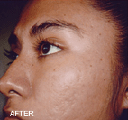 <?php echo $pk;?>  - Chemical Peels After Treatment 01