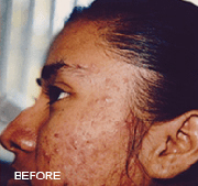 <?php echo $pk;?>  - Chemical Peels Before Treatment 01