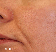 <?php echo $pk;?>  - Laser Genesis After Treatment 03