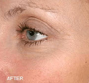 <?php echo $pk;?>  - Laser Genesis After Treatment 04