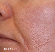 <?php echo $pk;?>  - Laser Genesis Before Treatment 03