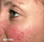<?php echo $pk;?>  - Laser Genesis Before Treatment 04