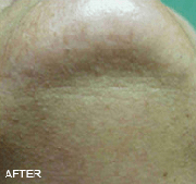 <?php echo $pk;?>  - Laser hair removal after treatment 01